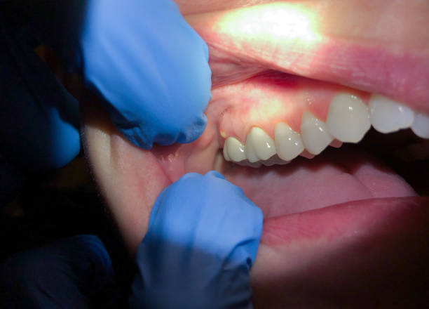 Best Emergency Treatment for Dental Infections or Abscesses in Sandy Hook, CT